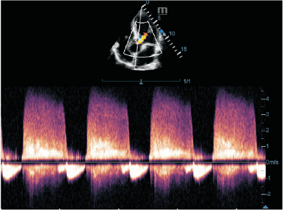 Doppler CW de régurgitation aortique