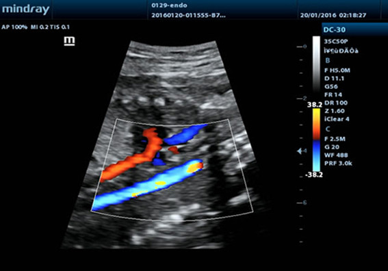 Flux de couleur aorte fœtale