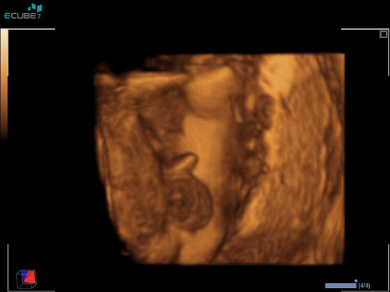 Imagerie 4D des organes génitaux du fœtus