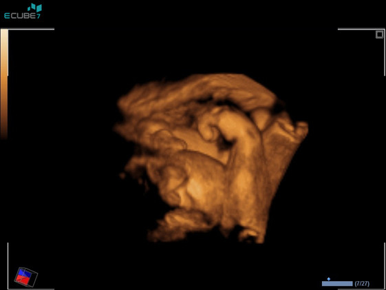 Main fœtale en imagerie 3D